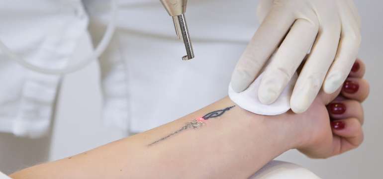 Laserové odstránenie tetovanie alebo PMU v Maya Beauty Clinic
