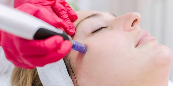 Omladzujúca mezoterapia - microneedling s chemickým peelingom + navyše úprava a farbenie obočia/Bratislava - Krasňany
