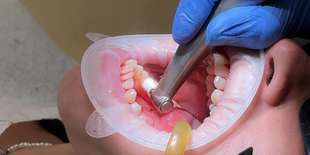 Dentálna hygiena alebo profesionálne bielenie v BL:K Dental Clinic