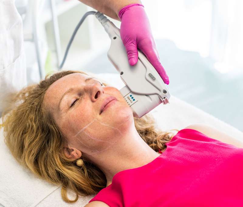 Neinvazívny facelifting Hifu SMAS ultherapia