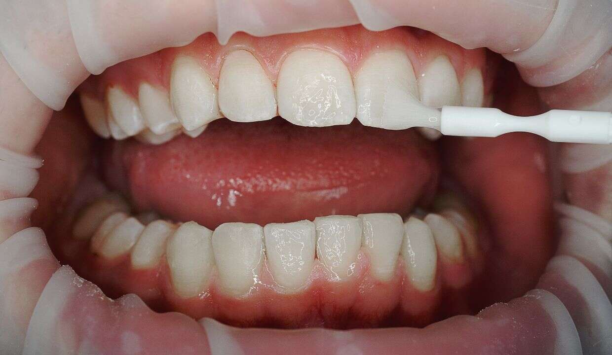 fluoridácia zubov, fluoridovaniie, fluorid 