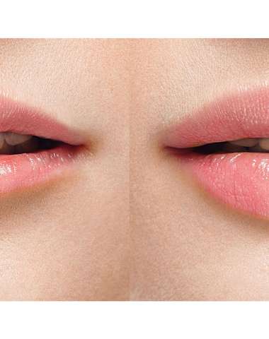 Aplikácia 1 ml kyseliny hyalurónovej Restylane Original