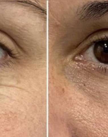 HIFU lifting, ktorý prirodzene omladí a zvýrazní vašu krásu v Amare Beauty