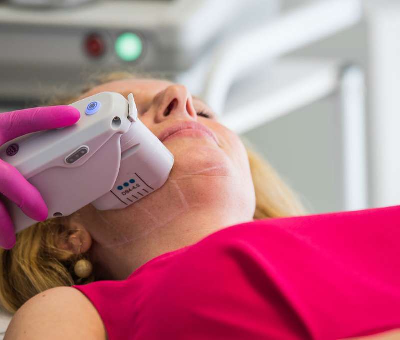 Neinvazívny facelifting Hifu SMAS ultherapia