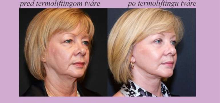 Vrásky po termoliftingu miznú, pleť sa vypína a kontúry tváre sú jasnejšie