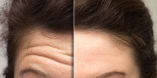 Rozlúčte sa s mimickými vráskami