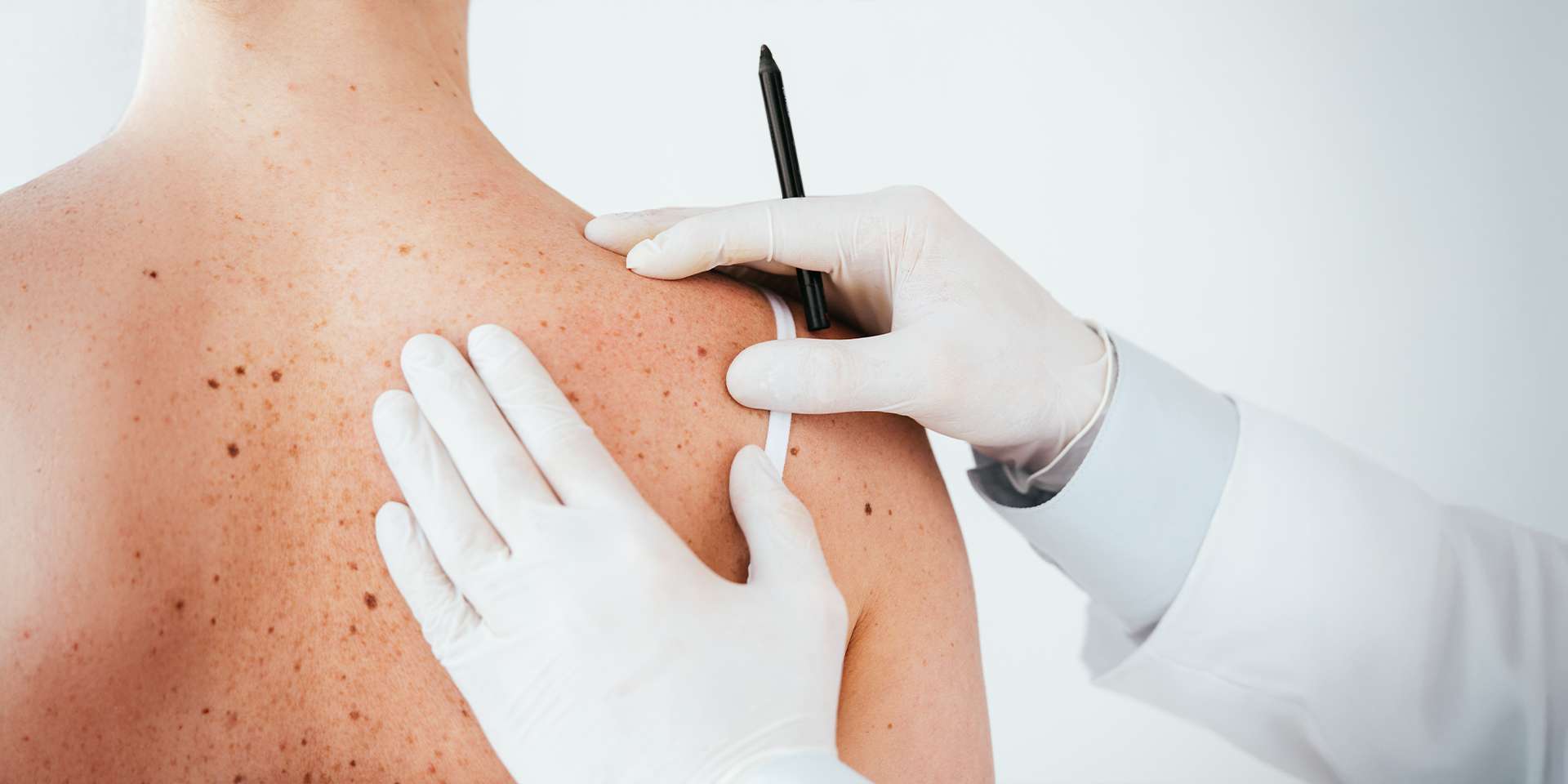 Vyšetrenia znamienok celotelovým skenom pomocou najmodernejšieho prístroja FotoFinder v SKYN Clinic