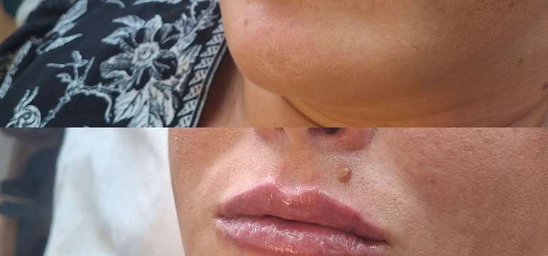 Revolučné bezbolestné zväčšenie Hyaluron Pen alebo hĺbková hydratácia Kiss Lips Therapy