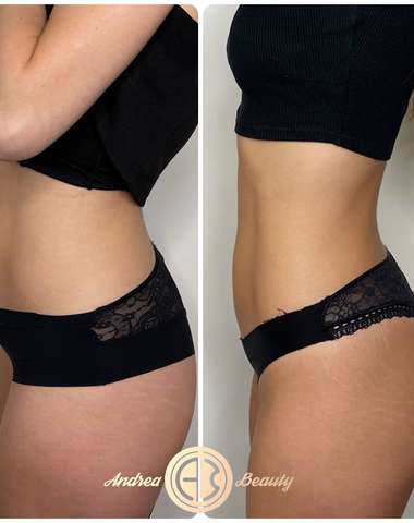 Termolifting brucha v salóne Andrea Beauty v Košiciach