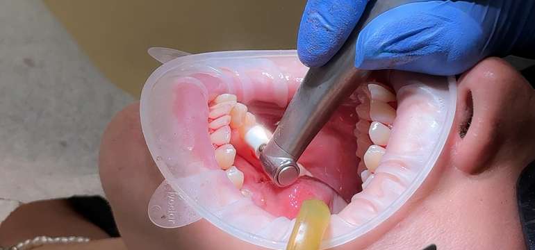 Dentálna hygiena alebo profesionálne bielenie v BL:K Dental Clinic