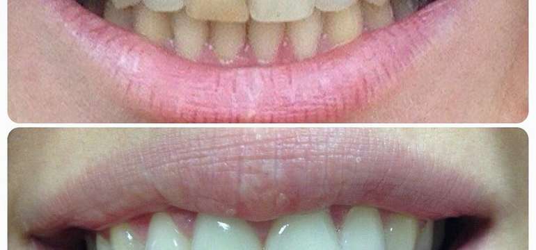 Dentálna hygiena s pieskovaním + medzizubná kefka zadarmo