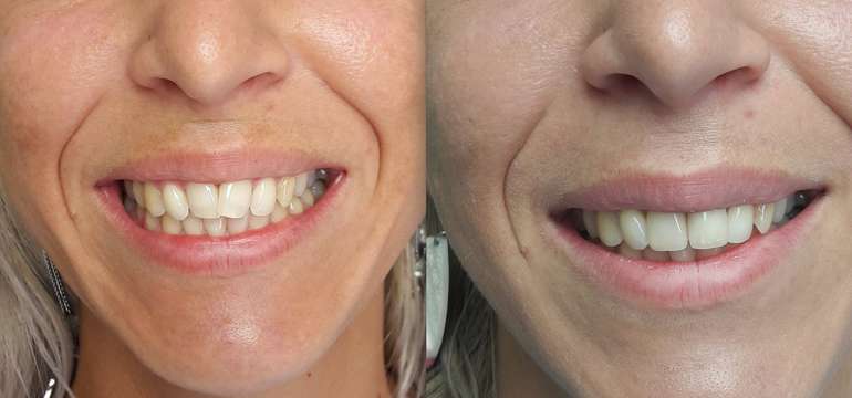 Dentálna hygiena s pieskovaním + medzizubná kefka zadarmo