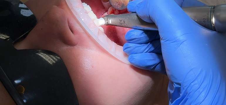 Dentálna hygiena alebo profesionálne bielenie v BL:K Dental Clinic