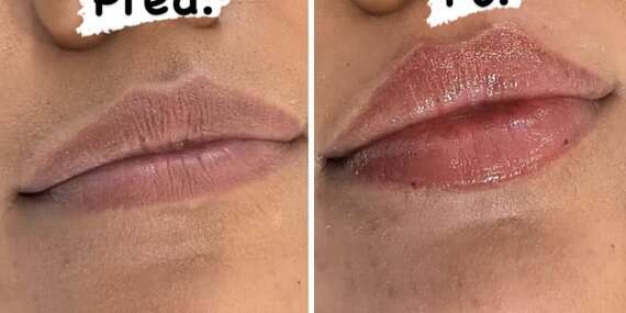 EXTRA CENA: Profesionálna výplň pier technikou Russianlips alebo hydratácia pier - kyselina hyalurónova na skúšku/Bratislava - Staré Mesto