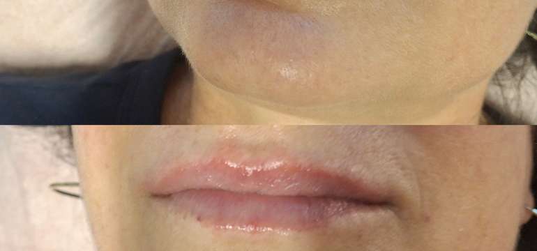 Revolučné bezbolestné zväčšenie Hyaluron Pen alebo hĺbková hydratácia Kiss Lips Therapy