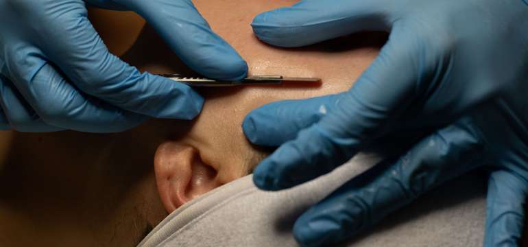 Dermaplaning - zamatovo hladká pleť bez ihiel