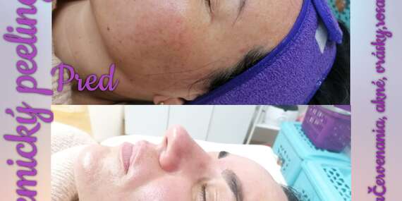 BLACK FRIDAY: Kyslíkové ošetrenie pleti, chemický peeling, mezoterapia či starostlivosť o problematickú pleť v salóne Beauty Ewei/Nemšová