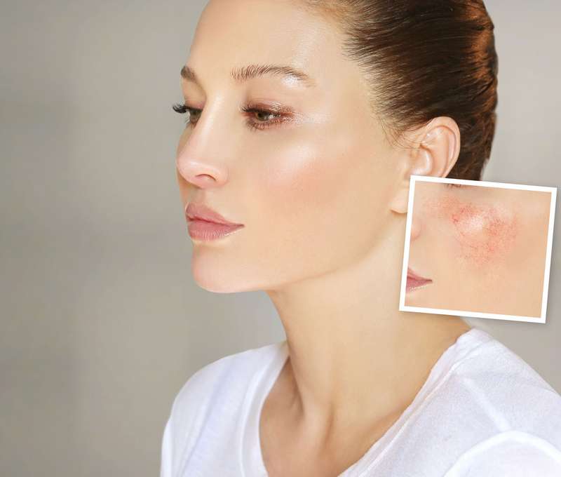 Fotorejuvenizácia - fotoomladenie tváre, krku a dekoltu pomocou intenzivného pulzného svetla IPL