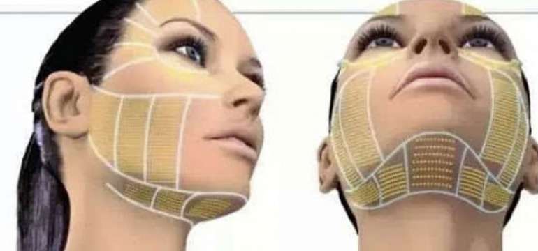 Hifu 3D - lifting tváre (Ultherapia)