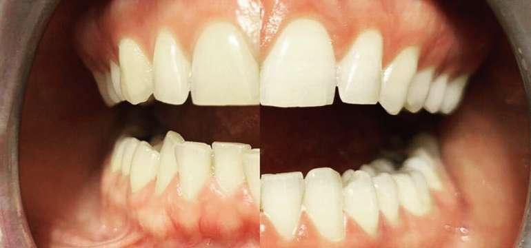 Krásne a zdravé zuby na počkanie – bielenie zubov do Dental Brothers