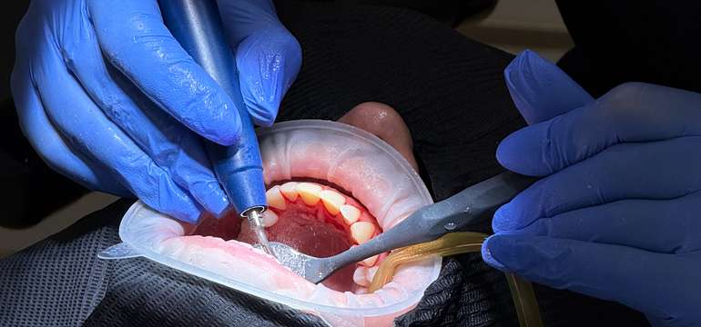 Dentálna hygiena alebo profesionálne bielenie v BL:K Dental Clinic