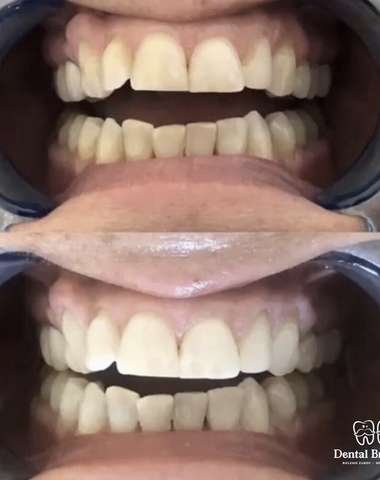 Krásne a zdravé zuby na počkanie – bielenie zubov do Dental Brothers
