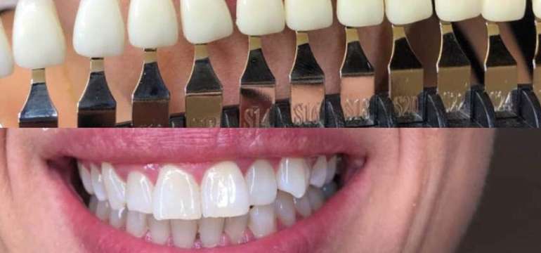 Krásne a zdravé zuby na počkanie – bielenie zubov do Dental Brothers
