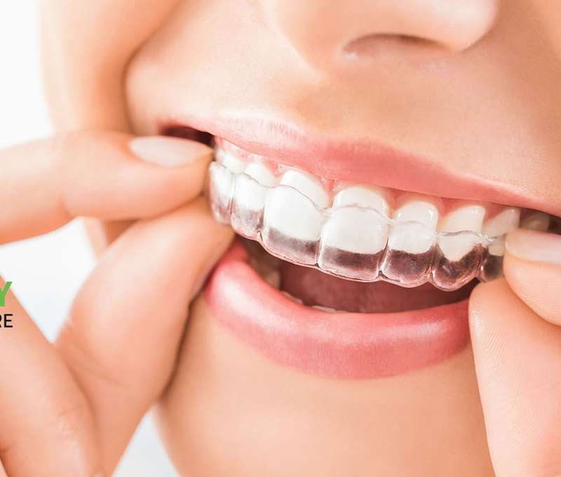 Neviditeľný zubný strojček Invisalign