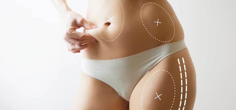 Tvarovanie svalov a redukcia tuku pomocou prístroja Body Sculpt