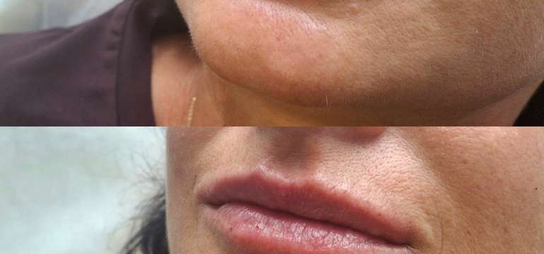 Revolučné bezbolestné zväčšenie Hyaluron Pen alebo hĺbková hydratácia Kiss Lips Therapy