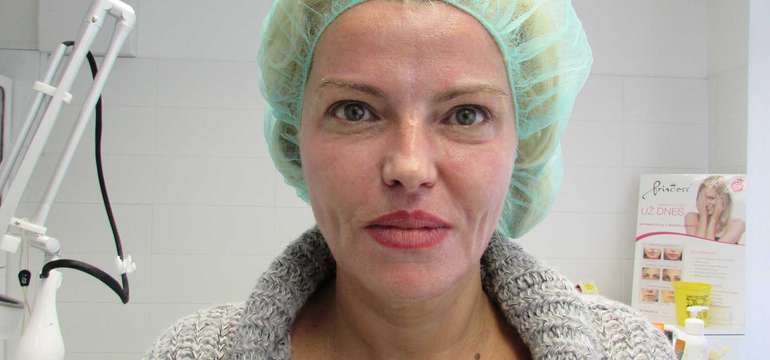 Frakčný resurfacing CO2 - účinné omladenie vašej pokožky v medicínskom centre Crystal Esthetic Clini