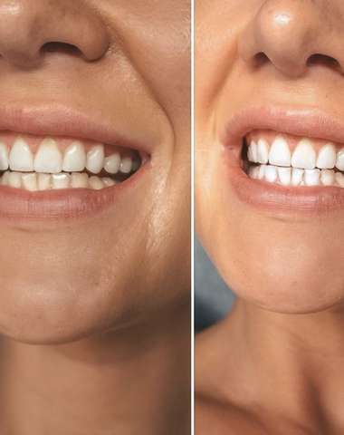 Krásne a zdravé zuby na počkanie – bielenie zubov do Dental Brothers