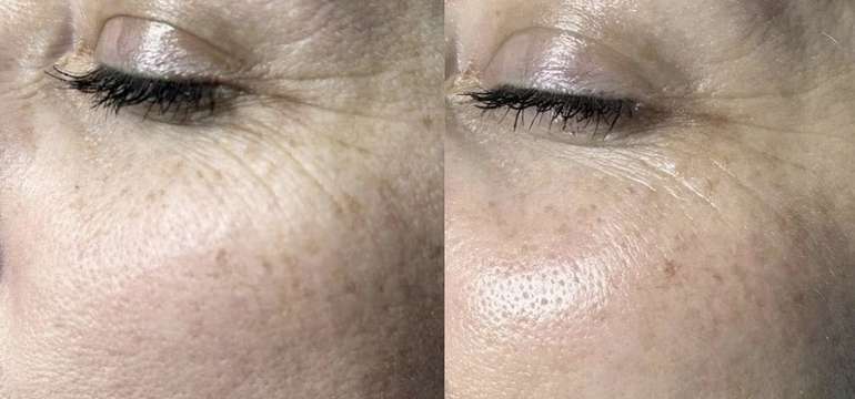 HIFU lifting, ktorý prirodzene omladí a zvýrazní vašu krásu v Amare Beauty