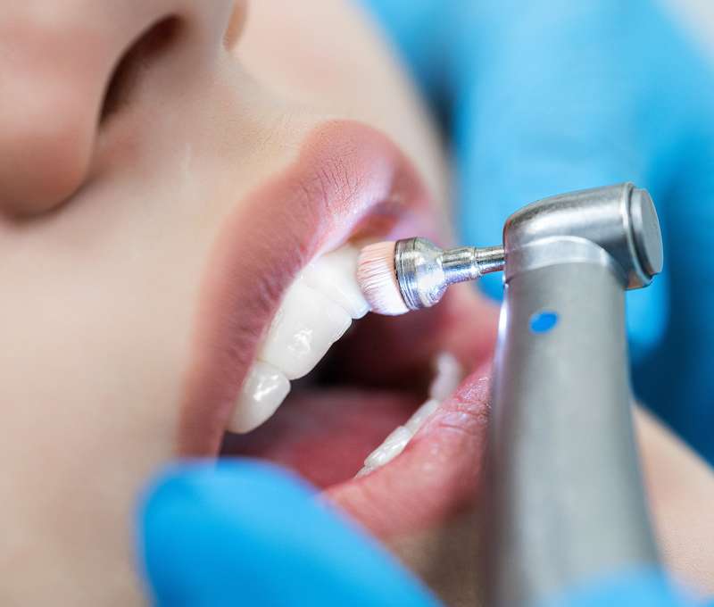 Profesionálna dentálna hygiena
