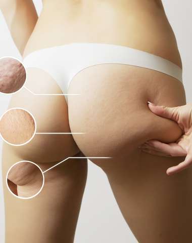 Efektívne odbúravanie tuku a redukcia celulitídy prístrojom PowerShape2 (ilustračné foto)