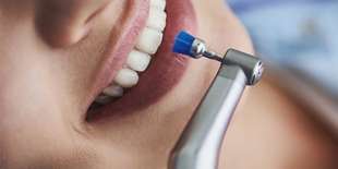 Profesionálna dentálna hygiena