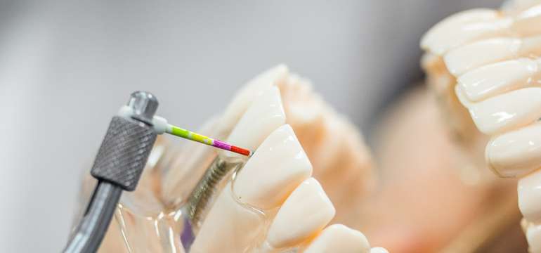 Profesionálna dentálna hygiena vo White Smile v Starom Meste