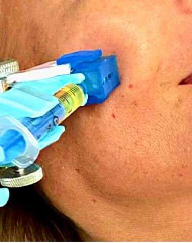 Ošetrenie prístrojom VITAL INJECTOR patrí k najnovším technikám omladenia pleti