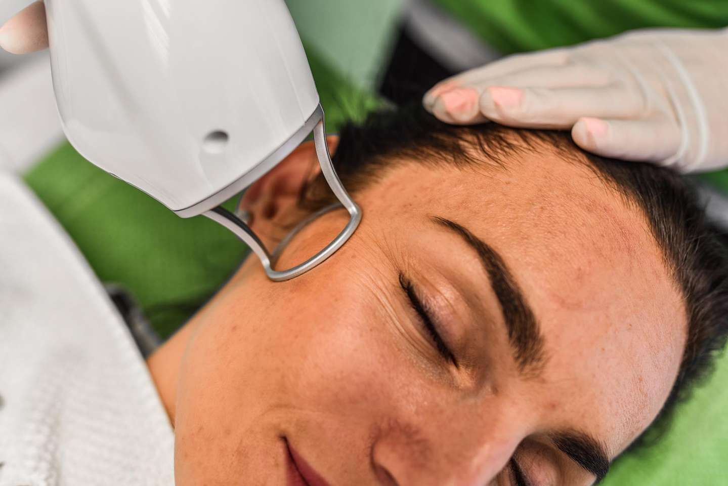 Frakčný resurfacing CO2 - účinné omladenie pokožky v medicínskom centre Crystal Esthetic Clinic