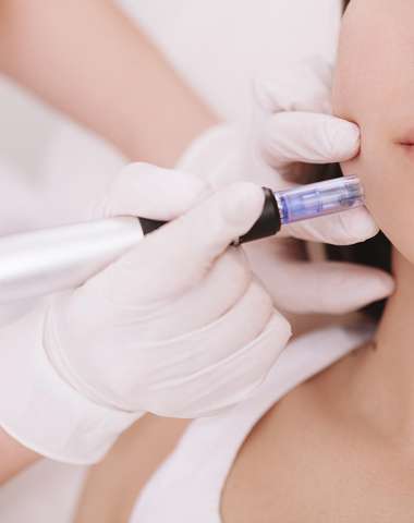 Mezoterapia v L&W beauty pomôže odstrániť jazvičky aj pigmentové škvrny