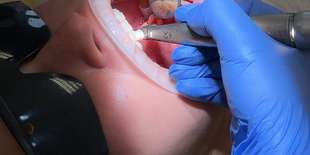Dentálna hygiena alebo profesionálne bielenie v BL:K Dental Clinic