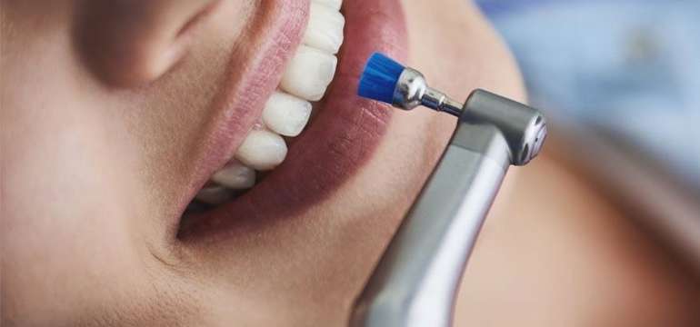 Profesionálna dentálna hygiena