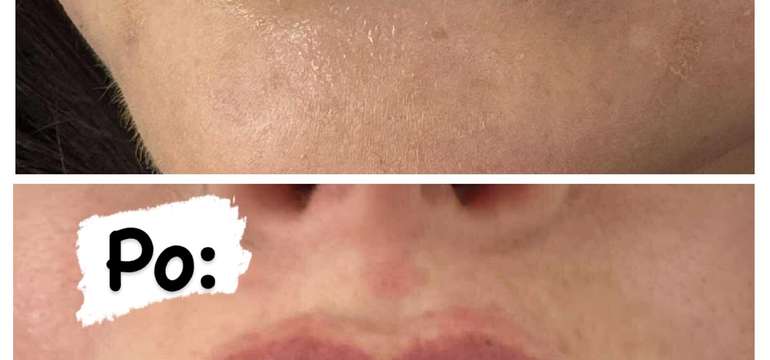 Russian Lips – profesionálna výplň pier kyselinou hyalurónovou