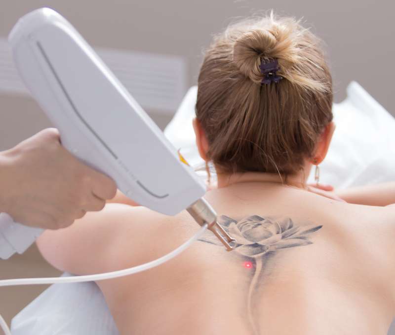 Laserové odstránenie tetovanie alebo PMU v Maya Beauty Clinic