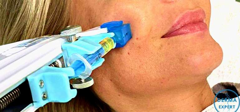 Ošetrenie prístrojom VITAL INJECTOR patrí k najnovším technikám omladenia pleti