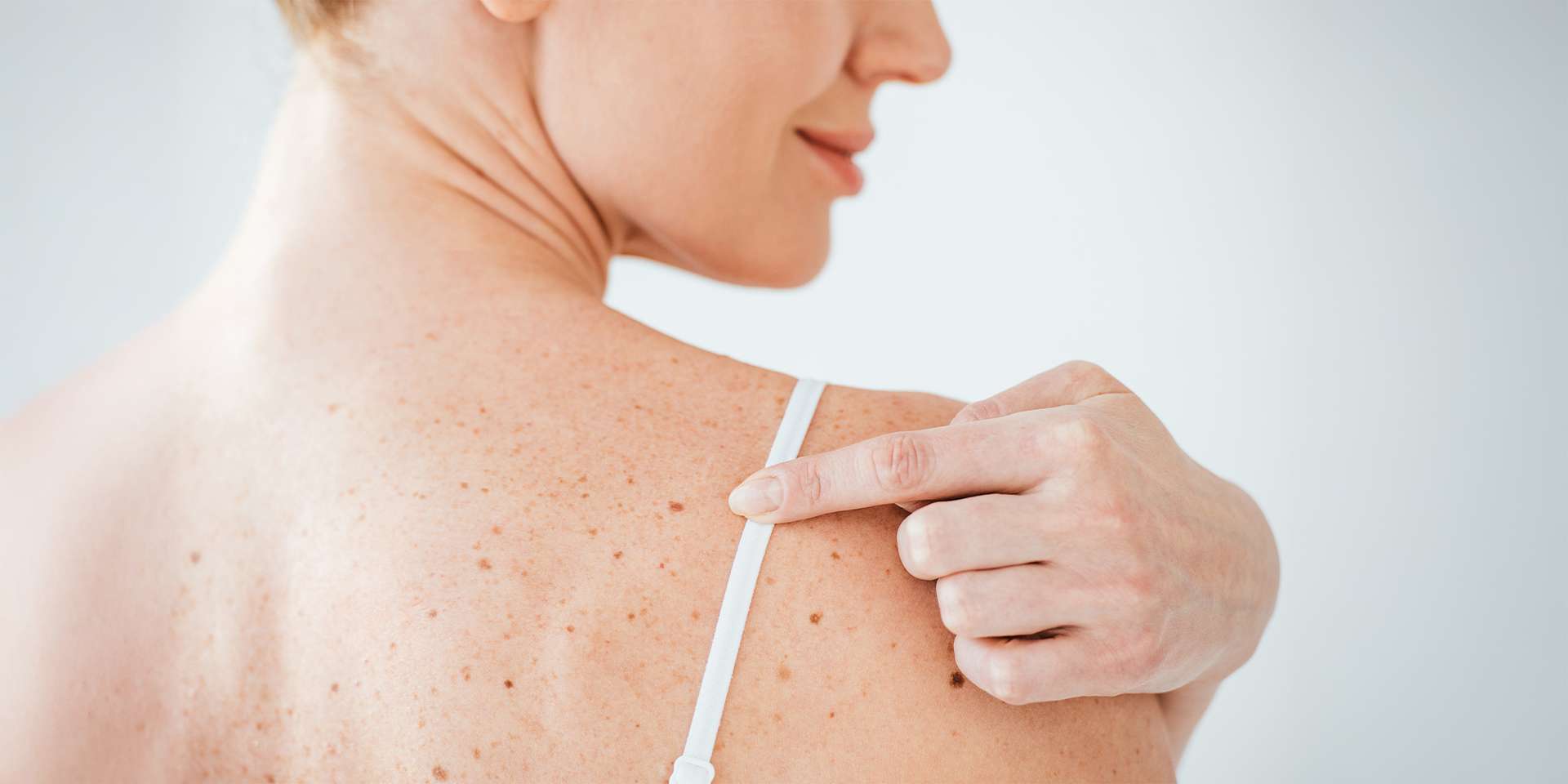 Vyšetrenia znamienok celotelovým skenom pomocou najmodernejšieho prístroja FotoFinder v SKYN Clinic