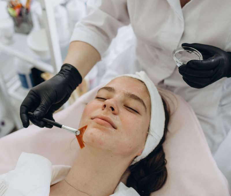 Efekt peelingu je exfoliácia, eliminácia jazvičiek, zjemnenie hyperpigmentácie