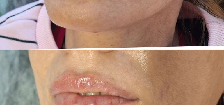 Revolučné bezbolestné zväčšenie Hyaluron Pen alebo hĺbková hydratácia Kiss Lips Therapy
