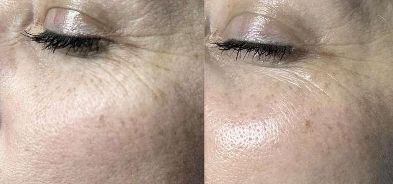 HIFU lifting, ktorý prirodzene omladí a zvýrazní vašu krásu v Amare Beauty