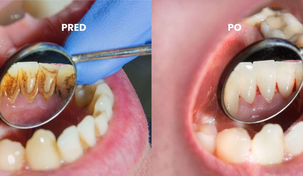 zubný kameň, odstránenie zubného kameňa, ultrazvuk 